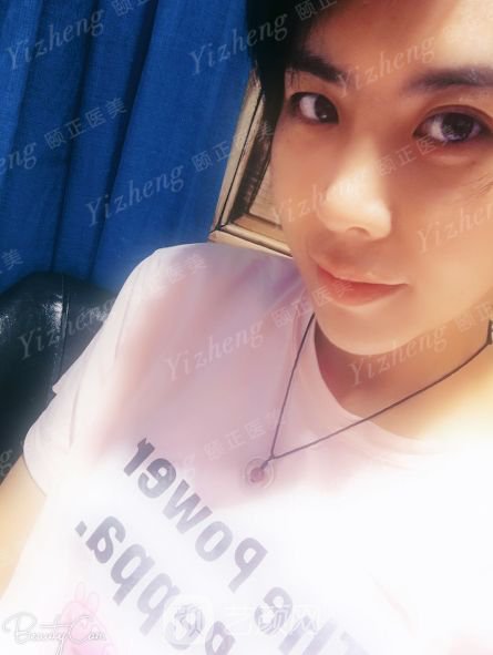 自體肋軟骨隆鼻+假體隆下頜一個月果照片分享~