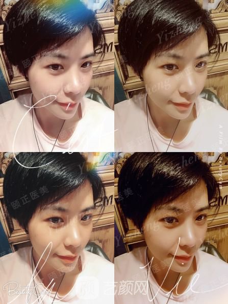 自體肋軟骨隆鼻+假體隆下頜一個月果照片分享~