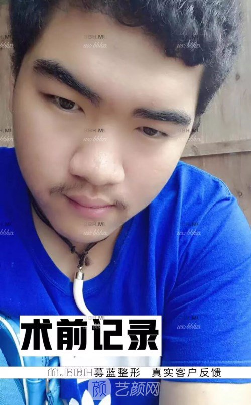 眼部手術(shù)案例——昆明募藍術(shù)后一年果照片分享~