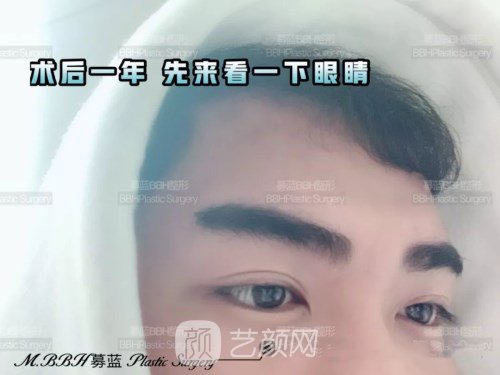 眼部手術(shù)案例——昆明募藍術(shù)后一年果照片分享~