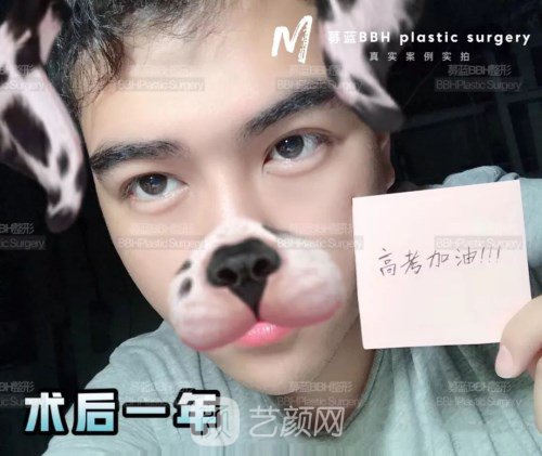 眼部手術(shù)案例——昆明募藍術(shù)后一年果照片分享~