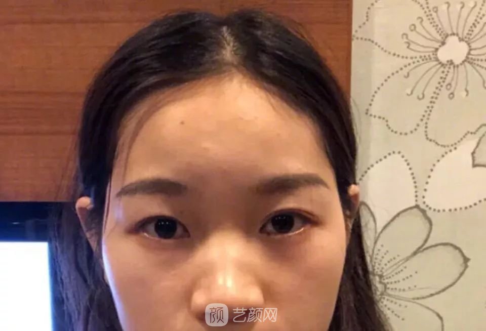 鼻部手術(shù)一個月恢復(fù)日記分享~