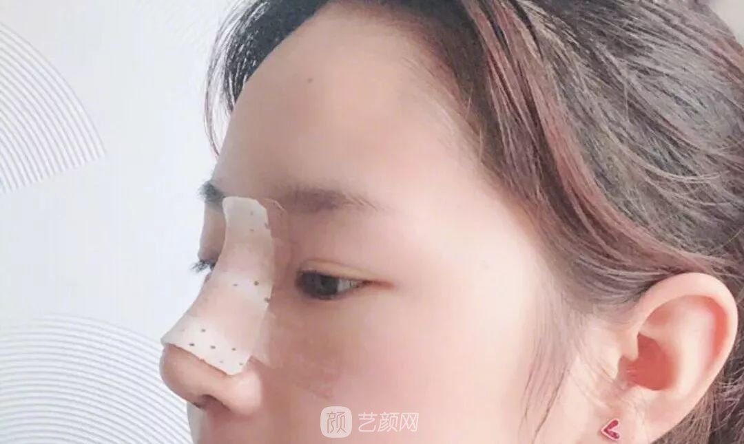 鼻部手術(shù)一個月恢復(fù)日記分享~