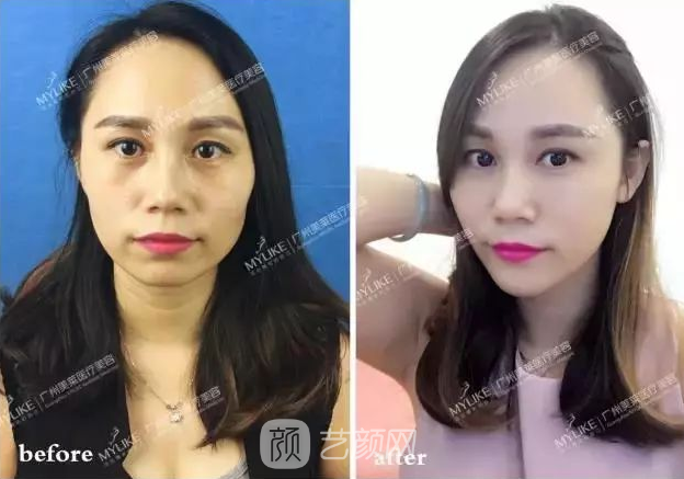 廣州美萊玻尿酸全臉填充果照片分享~