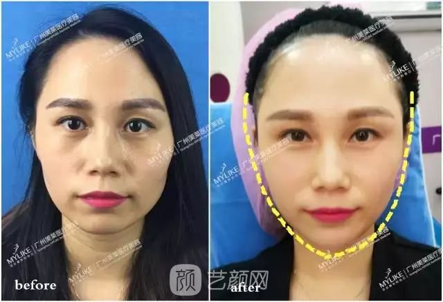 廣州美萊玻尿酸全臉填充果照片分享~