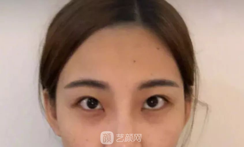 眼部手術(shù)一個(gè)月恢復(fù)日記，片分享~