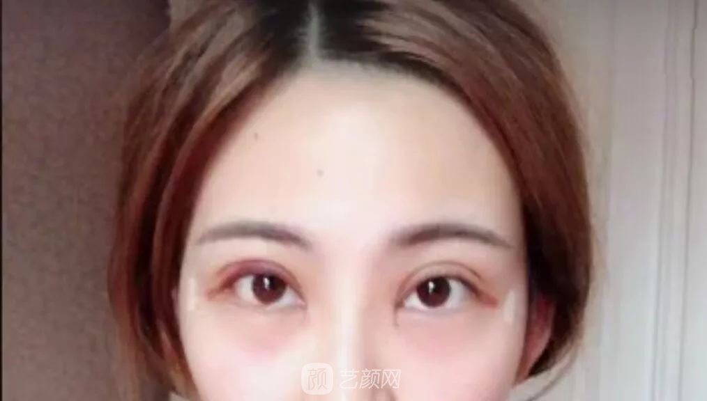 眼部手術(shù)一個(gè)月恢復(fù)日記，片分享~