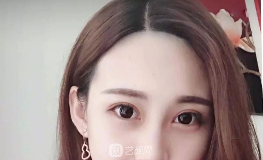 眼部手術(shù)一個(gè)月恢復(fù)日記，片分享~