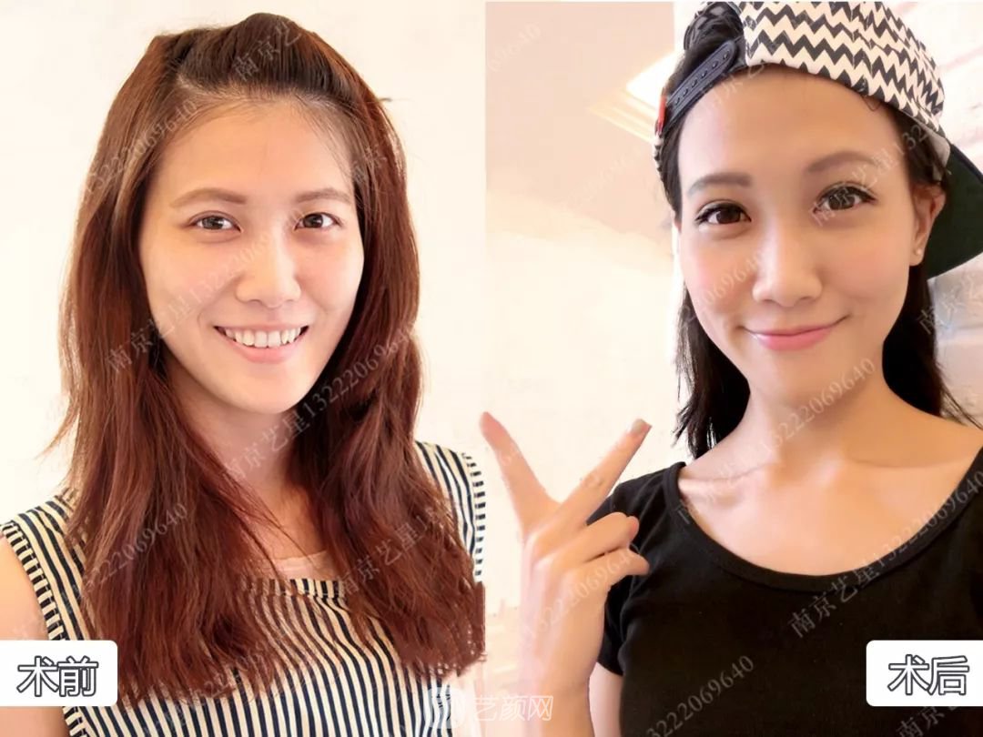 Yestar美杜莎美眼術(shù)一周案例圖片，芭比雙眼皮果很好~