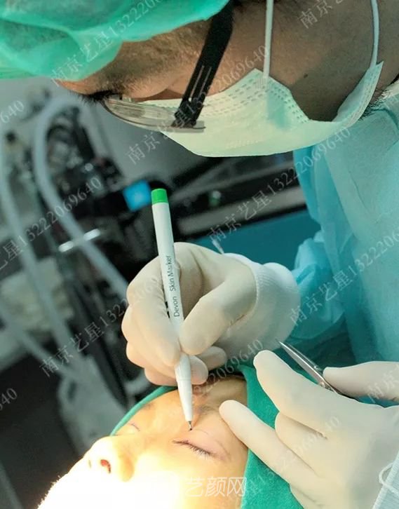 Yestar美杜莎美眼術(shù)一周案例圖片，芭比雙眼皮果很好~