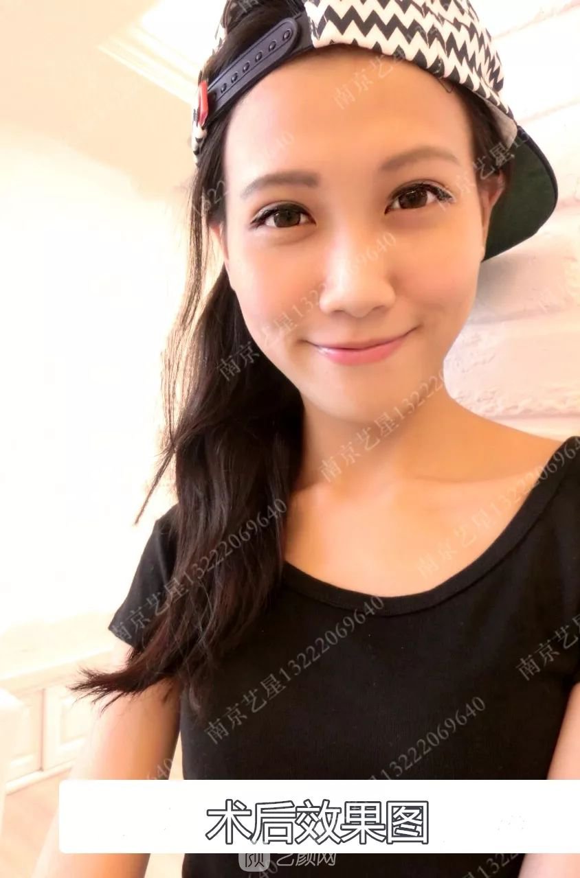 Yestar美杜莎美眼術(shù)一周案例圖片，芭比雙眼皮果很好~