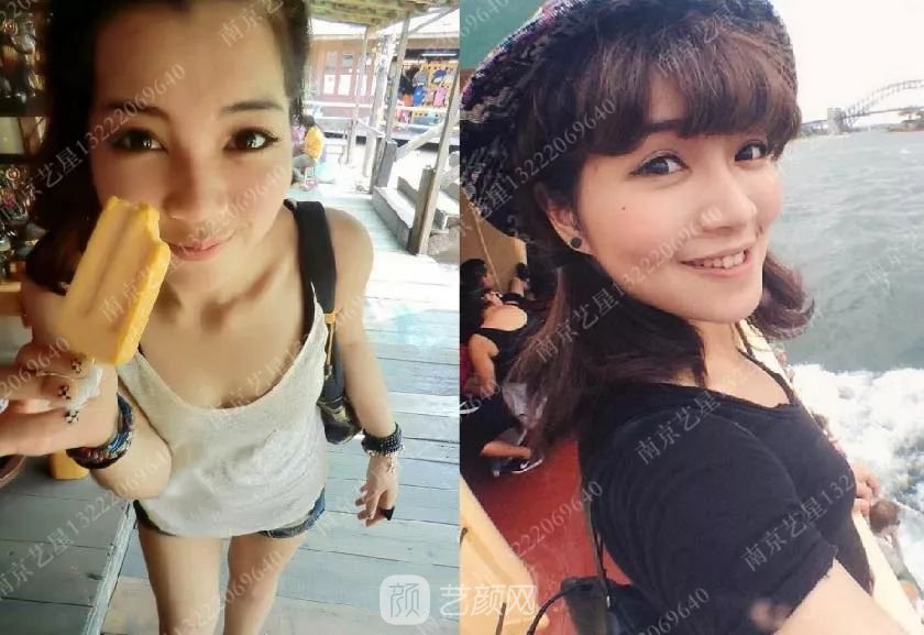 南京藝星自體脂肪豐胸術(shù)一個(gè)月案例分享~