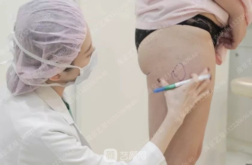 南京藝星自體脂肪豐胸術(shù)一個(gè)月案例分享~