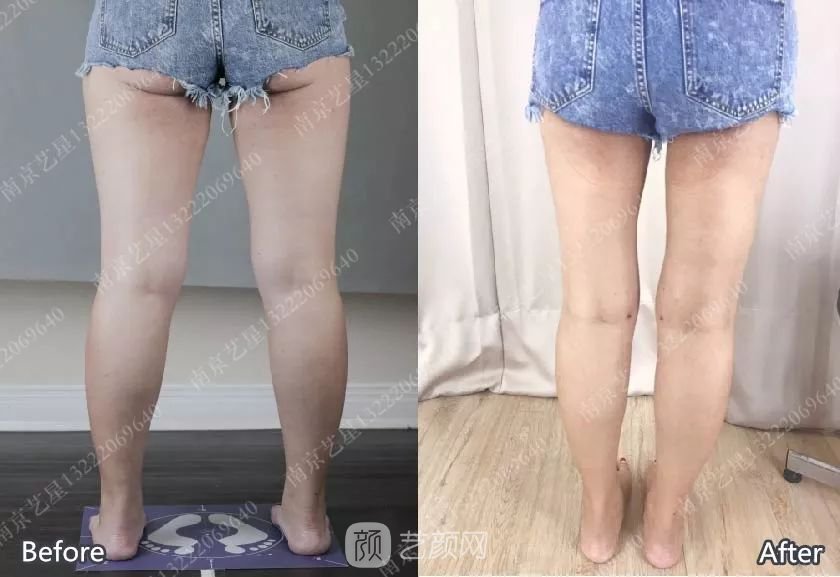 南京藝星自體脂肪豐胸術(shù)一個(gè)月案例分享~