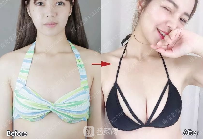 南京藝星自體脂肪豐胸術(shù)一個(gè)月案例分享~