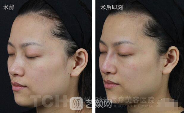 玻尿酸隆鼻案例