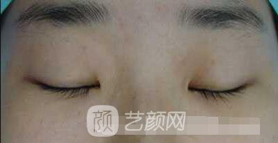 張嬌嬌醫(yī)生做的小切口雙眼皮手術(shù)案例