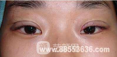 張嬌嬌醫(yī)生做的小切口雙眼皮手術(shù)案例