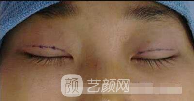 張嬌嬌醫(yī)生做的小切口雙眼皮手術(shù)案例