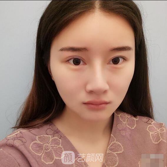 顴骨內(nèi)推真實(shí)案例，小臉網(wǎng)紅模板臉型