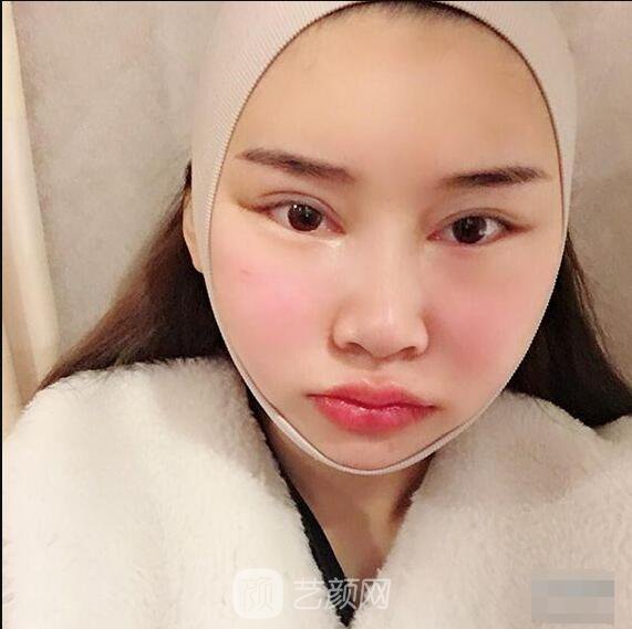 顴骨內(nèi)推真實(shí)案例，小臉網(wǎng)紅模板臉型