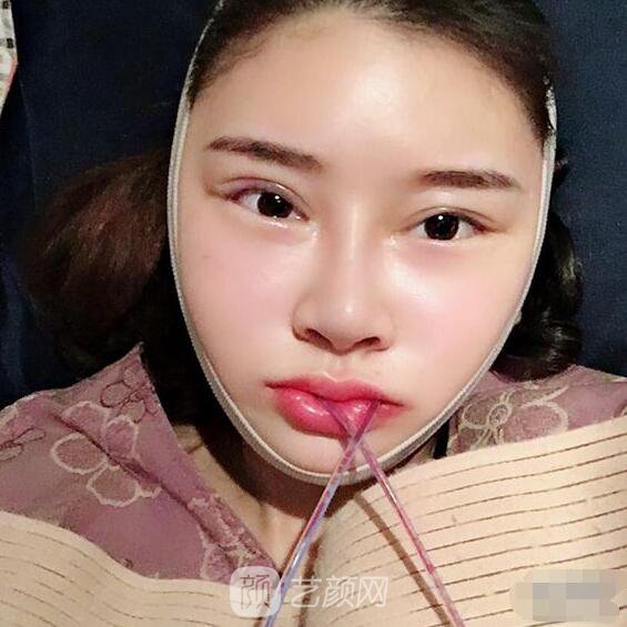 顴骨內(nèi)推真實(shí)案例，小臉網(wǎng)紅模板臉型