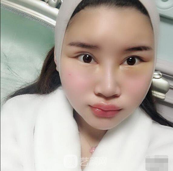 顴骨內(nèi)推真實(shí)案例，小臉網(wǎng)紅模板臉型