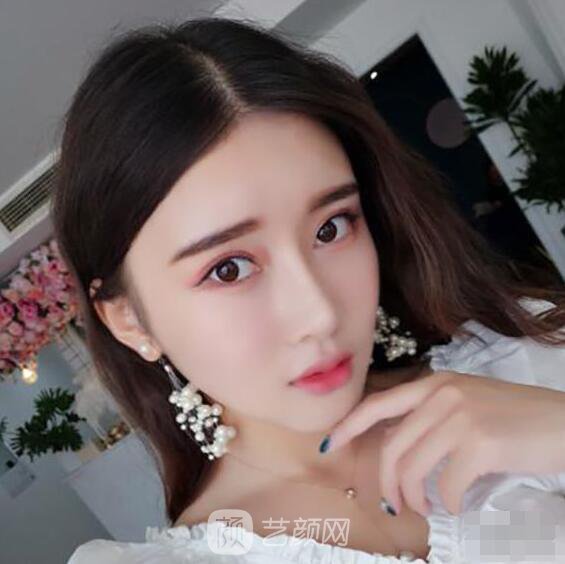 顴骨內(nèi)推真實(shí)案例，小臉網(wǎng)紅模板臉型