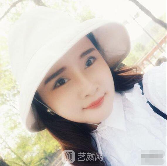 顴骨內(nèi)推真實(shí)案例，小臉網(wǎng)紅模板臉型