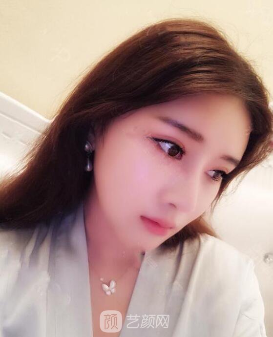 顴骨內(nèi)推真實(shí)案例，小臉網(wǎng)紅模板臉型