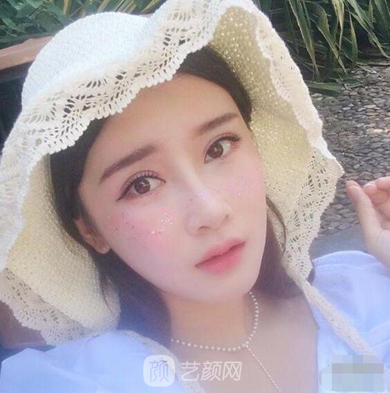 顴骨內(nèi)推真實(shí)案例，小臉網(wǎng)紅模板臉型