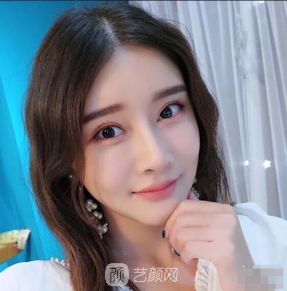 顴骨內(nèi)推真實(shí)案例，小臉網(wǎng)紅模板臉型