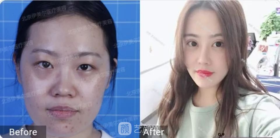 伊美爾幸福李輝靈動面部年輕化術(shù)后兩個月恢復(fù)日記~