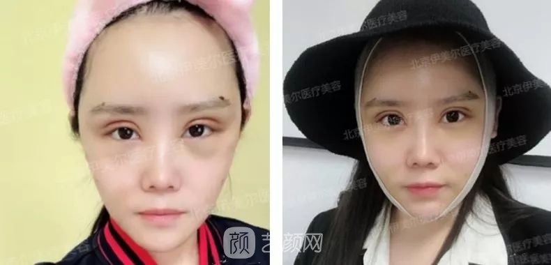 伊美爾幸福李輝靈動面部年輕化術(shù)后兩個月恢復(fù)日記~