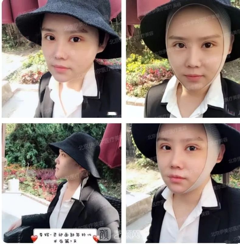 伊美爾幸福李輝靈動面部年輕化術(shù)后兩個月恢復(fù)日記~