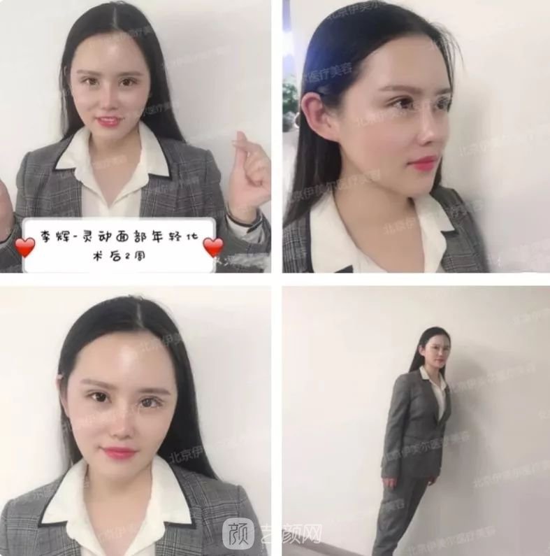 伊美爾幸福李輝靈動面部年輕化術(shù)后兩個月恢復(fù)日記~