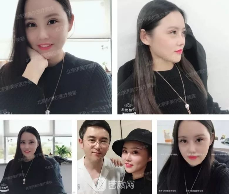 伊美爾幸福李輝靈動面部年輕化術(shù)后兩個月恢復(fù)日記~