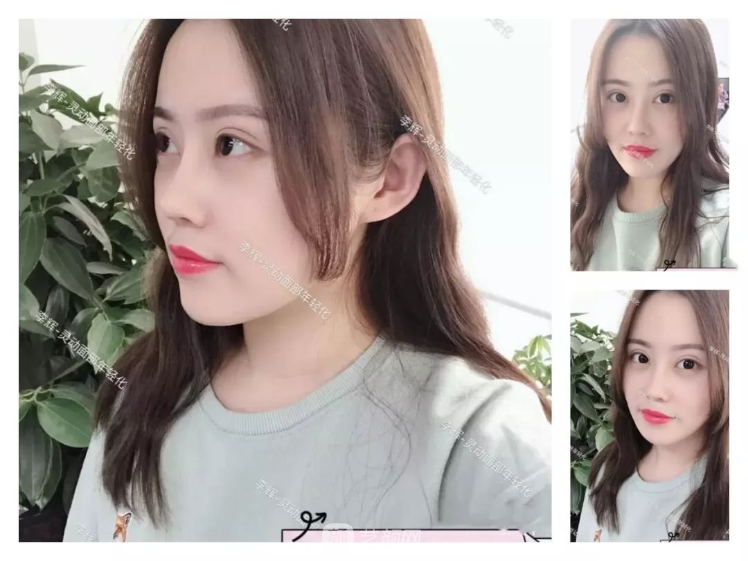 伊美爾幸福李輝靈動面部年輕化術(shù)后兩個月恢復(fù)日記~