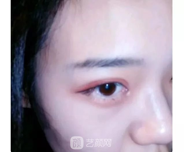 脂美人雙眼皮手術(shù)大公開(kāi)！我終于整容了！