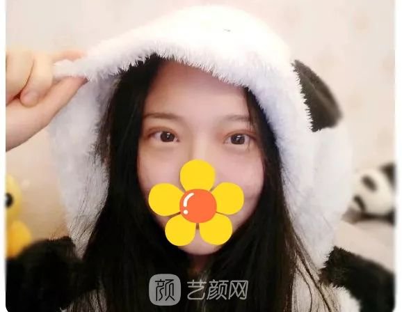 脂美人雙眼皮手術(shù)大公開(kāi)！我終于整容了！