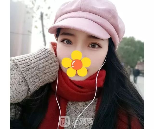 脂美人雙眼皮手術(shù)大公開(kāi)！我終于整容了！