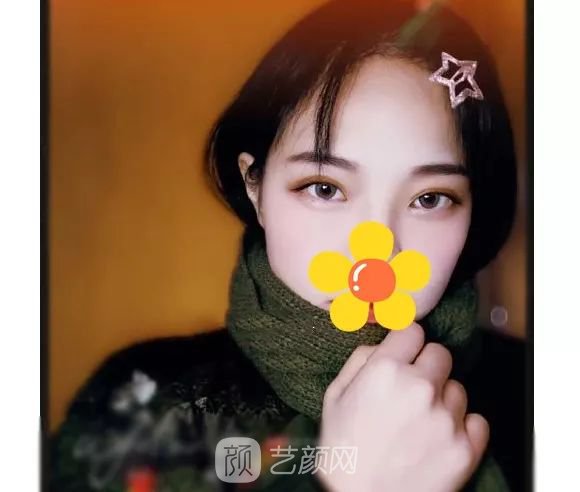 脂美人雙眼皮手術(shù)大公開(kāi)！我終于整容了！