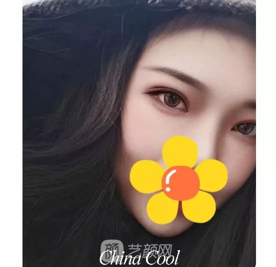 脂美人雙眼皮手術(shù)大公開(kāi)！我終于整容了！