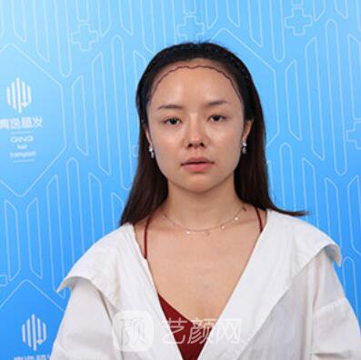 做好發(fā)際線后堪比微調(diào)的真實經(jīng)歷分享