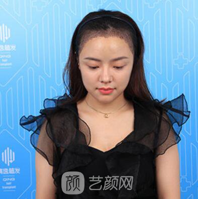 做好發(fā)際線后堪比微調(diào)的真實經(jīng)歷分享