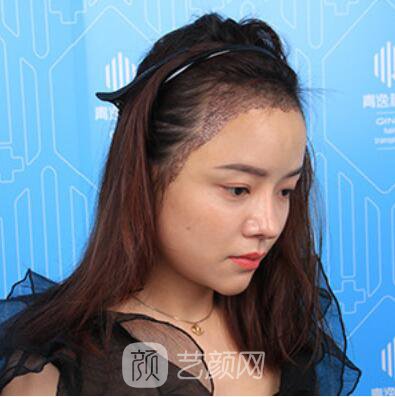 做好發(fā)際線后堪比微調(diào)的真實經(jīng)歷分享