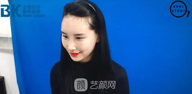 【新西蘭美女整形日記】鼻部手術+面部脂肪移植——BK整形醫(yī)院