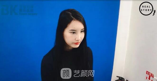 【新西蘭美女整形日記】鼻部手術+面部脂肪移植——BK整形醫(yī)院