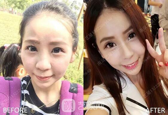 只需要5分鐘，我的鼻子變高了！——南京藝星玻尿酸隆鼻~