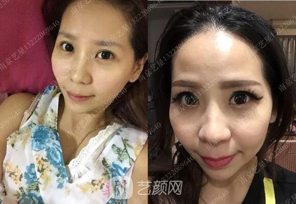 只需要5分鐘，我的鼻子變高了！——南京藝星玻尿酸隆鼻~